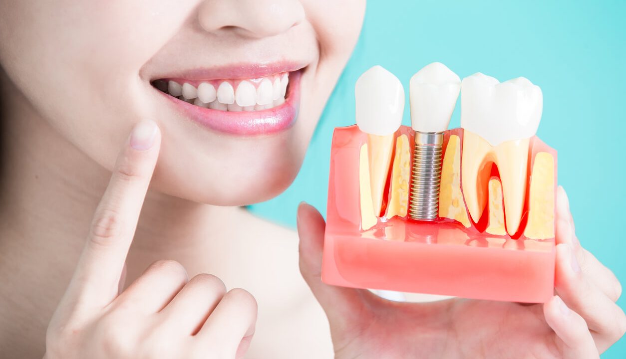 Easy Dental Implants: Your Quick Guide To A Confident Smile